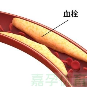 试管移植后，为啥不能一直躺着？血栓风险了解一下！