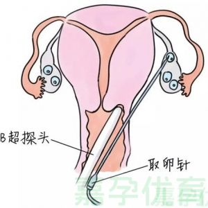 取卵后多久能再次出发？门道可多着呢！