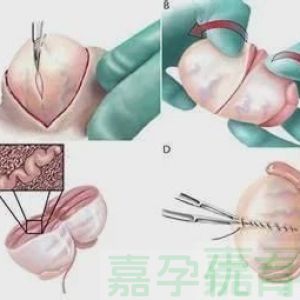 打破生育僵局：睾丸显微取精术，给无精子症患者带来新希望