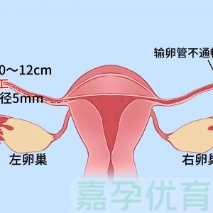 输卵管堵了咋选？做手术还是直接试管？这篇帮你理清楚​