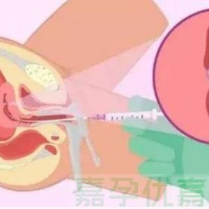 试管婴儿移植：胚胎数量有讲究